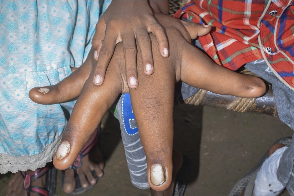 Η μάχη του 8χρονου Καλήμ για μια φυσιολογική ζωή [εικόνες] | iefimerida.gr 1