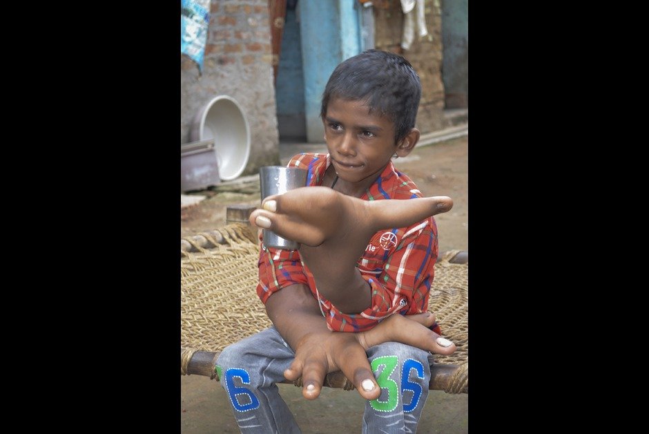 Η μάχη του 8χρονου Καλήμ για μια φυσιολογική ζωή [εικόνες] | iefimerida.gr 3