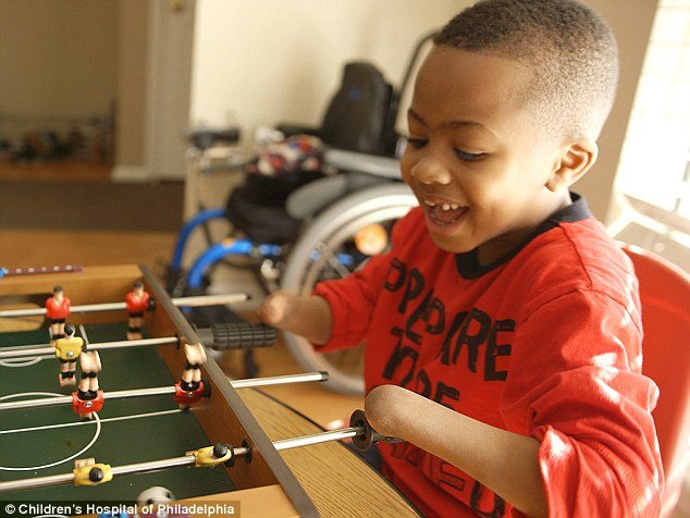 8χρονος γίνεται το πρώτο παιδί που υποβλήθηκε σε μεταμόσχευση και των δύο χεριών [εικόνες] | iefimerida.gr 1