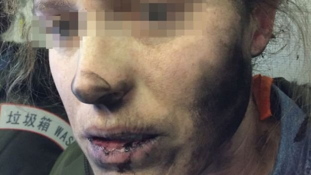 Απίστευτο: Εξερράγησαν τα ακουστικά της εν μέσω πτήσης και της έκαψαν το πρόσωπο [εικόνες]  | iefimerida.gr 0