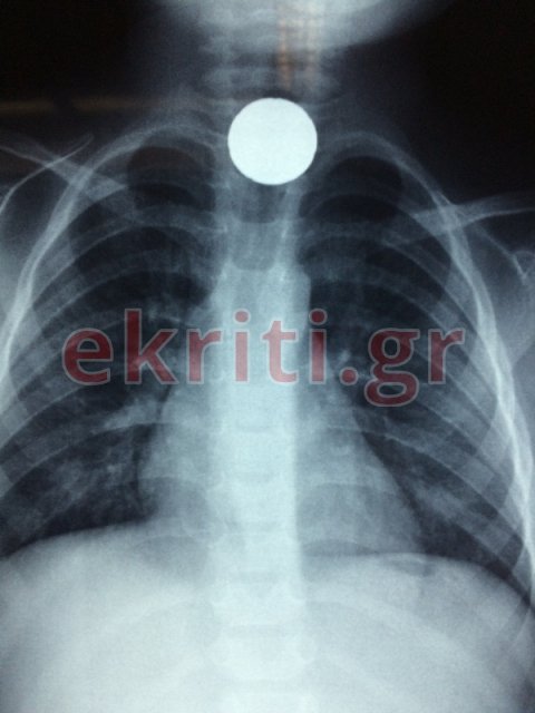 Ηράκλειο: Περιπέτεια για ένα αγοράκι δύο ετών -Κατάπιε κέρμα [εικόνα] | iefimerida.gr 0