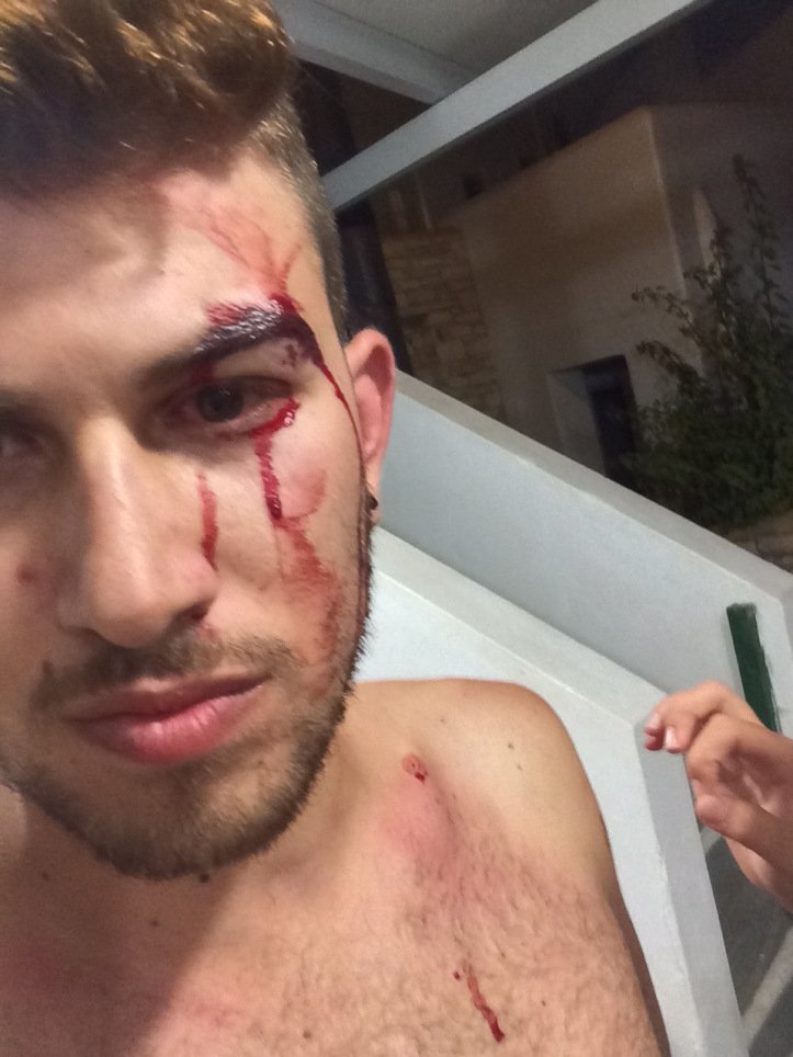 Ιταλοί ξυλοκόπησαν νεαρό Ελληνα στην Πάρο για το ντύσιμό του -Τι καταγγέλλει το θύμα στο iefimerida.gr [εικόνες] | iefimerida.gr 3