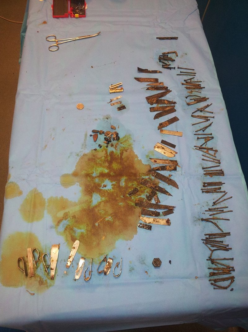 Γιατροί αφαίρεσαν πάνω από 100 μεταλλικά αντικείμενα από το στομάχι άνδρα! [εικόνα] | iefimerida.gr 0