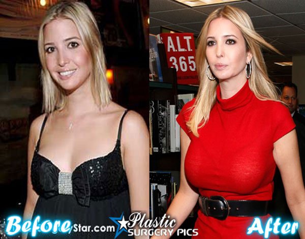 Αμερικανίδες κάνουν τα πάντα για να μοιάζουν με την... Ιβάνκα  Τραμπ-Δίνουν μέχρι και 90.000 δολ. σε πλαστικές [εικόνες] | iefimerida.gr 11