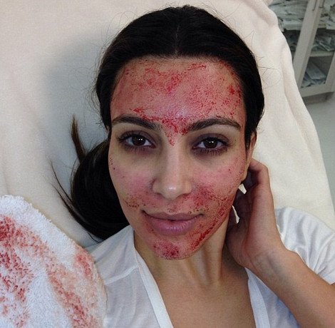 Ανατριχιαστικές εικόνες - Η Κιμ Καρντάσιαν πνίγηκε στο αίμα για χάρη της ομορφιάς [εικόνες] | iefimerida.gr 5