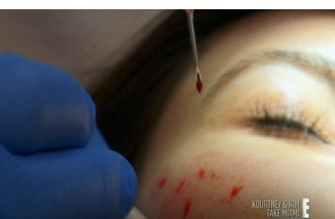 Ανατριχιαστικές εικόνες - Η Κιμ Καρντάσιαν πνίγηκε στο αίμα για χάρη της ομορφιάς [εικόνες] | iefimerida.gr 0