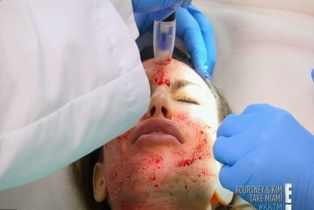 Ανατριχιαστικές εικόνες - Η Κιμ Καρντάσιαν πνίγηκε στο αίμα για χάρη της ομορφιάς [εικόνες] | iefimerida.gr 1