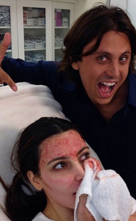 Ανατριχιαστικές εικόνες - Η Κιμ Καρντάσιαν πνίγηκε στο αίμα για χάρη της ομορφιάς [εικόνες] | iefimerida.gr 2