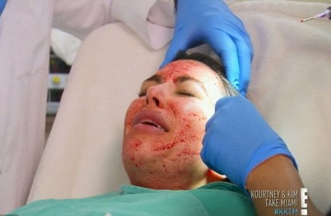 Ανατριχιαστικές εικόνες - Η Κιμ Καρντάσιαν πνίγηκε στο αίμα για χάρη της ομορφιάς [εικόνες] | iefimerida.gr 4