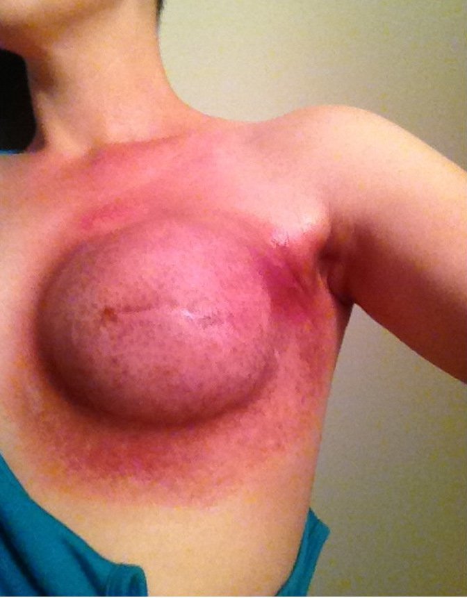 Μια μητέρα δείχνει πώς είναι να έχεις καρκίνο του μαστού: «Καμένο δέρμα και ραγισμένες καρδιές» [εικόνες] | iefimerida.gr 0