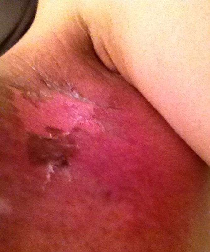 Μια μητέρα δείχνει πώς είναι να έχεις καρκίνο του μαστού: «Καμένο δέρμα και ραγισμένες καρδιές» [εικόνες] | iefimerida.gr 1