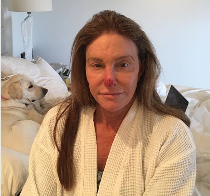 Η Κέιτλιν Τζένερ μόλις έβγαλε έναν μικρό καρκίνο από τη μύτη της [εικόνα] | iefimerida.gr 0