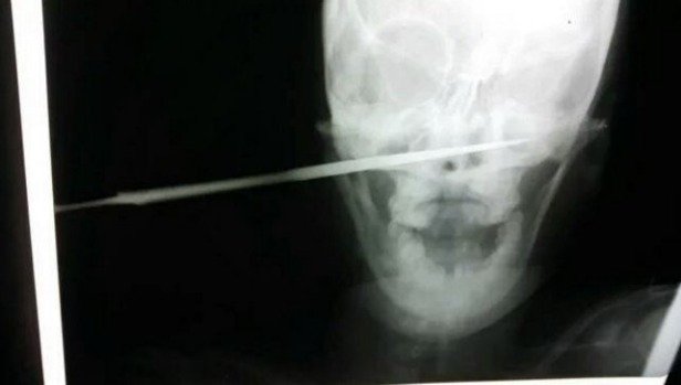 Κένυα: Κατακραυγή έχει προκαλέσει στην χώρα το μαχαίρωμα στο πρόσωπο μιας γυναίκας από τον σύζυγο της [εικόνες] | iefimerida.gr 0