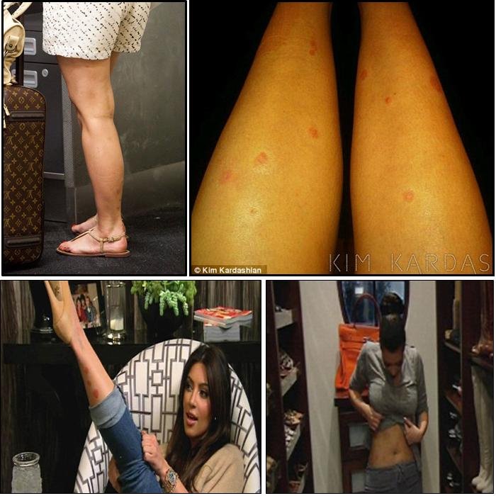 Η άγνωστη αρρώστια της Κιμ Καρντάσιαν [εικόνες] | iefimerida.gr 7