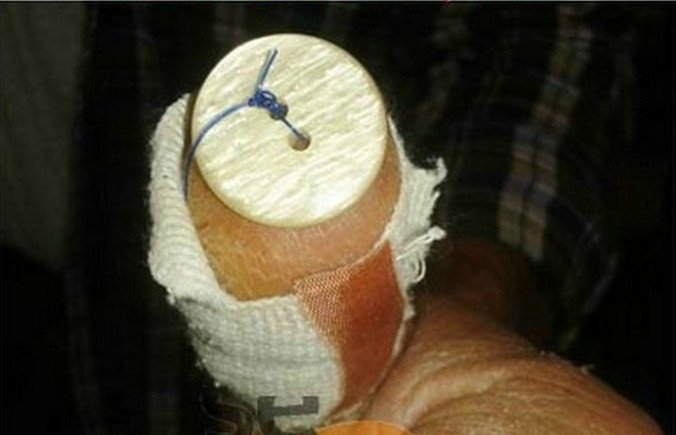 Απίστευτο -Σε νοσοκομείο της Θεσσαλονίκης έκλεισαν πληγή ράβοντάς τη με... κουμπί [εικόνες] | iefimerida.gr 0