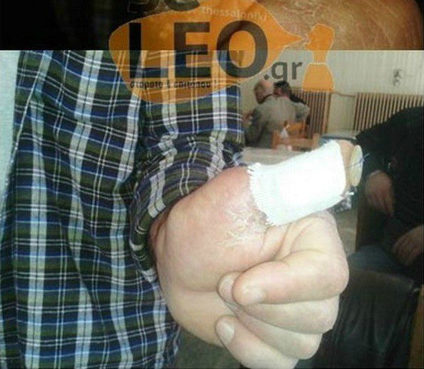 Απίστευτο -Σε νοσοκομείο της Θεσσαλονίκης έκλεισαν πληγή ράβοντάς τη με... κουμπί [εικόνες] | iefimerida.gr 1