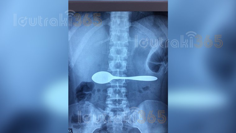 Απίστευτο: Πήγε στο νοσοκομείο γιατί είχε καταπιεί ένα κουτάλι [εικόνα] | iefimerida.gr 0