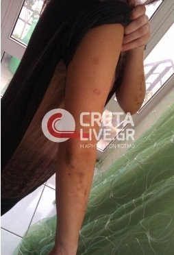 Απίστευτη περιπέτεια για μία γυναίκα από την Κρήτη -Πήγε για αποτρίχωση και έφυγε με σοβαρά εγκαύματα [εικόνα] | iefimerida.gr 0