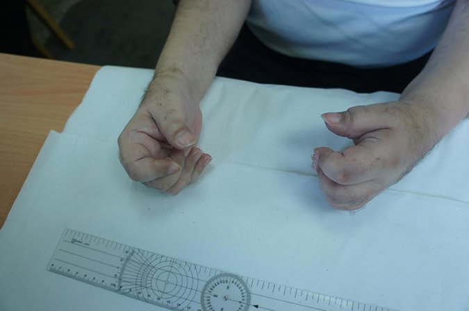 Κινδυνεύει η ζωή του Λαυρεντιάδη, λένε οι δικηγόροι του -Σε αχρηστία τα άνω άκρα του [εικόνες] | iefimerida.gr 0