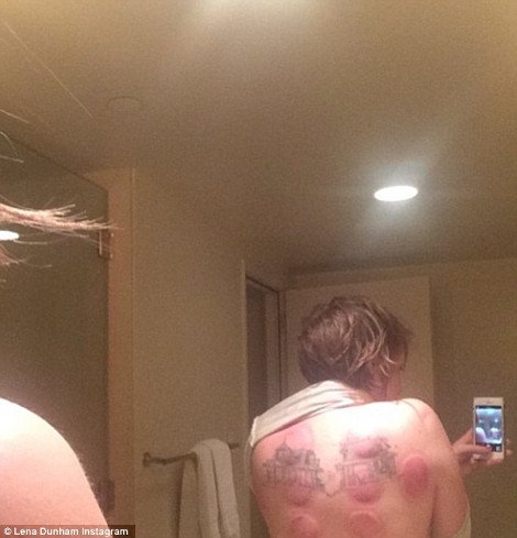 Στο Χόλιγουντ δεν παίρνουν αντιβίωση κάνουν βεντούζες -Η αηδιαστικά μελανιασμένη πλάτη γνωστής ηθοποιού [εικόνα] | iefimerida.gr 0