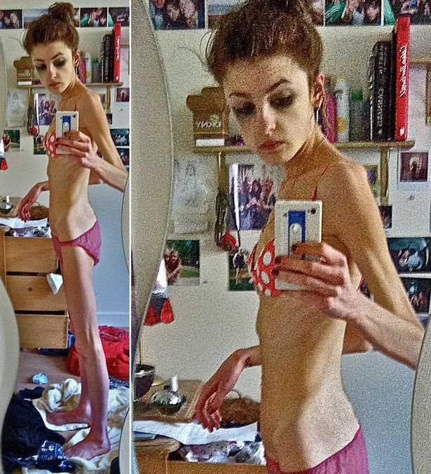 Η φοιτήτρια που έγινε ανορεκτική μετά από ένα one night stand και ζούσε με 13 θερμίδες την ημέρα [εικόνες] | iefimerida.gr 0