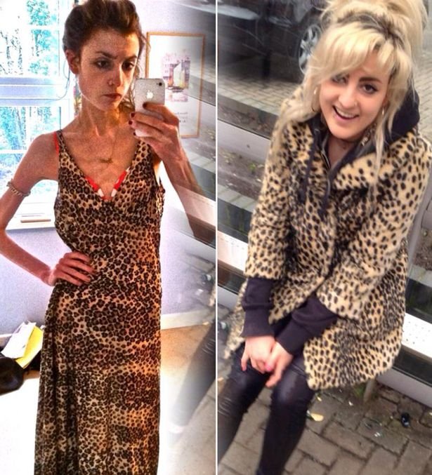 Η φοιτήτρια που έγινε ανορεκτική μετά από ένα one night stand και ζούσε με 13 θερμίδες την ημέρα [εικόνες] | iefimerida.gr 1