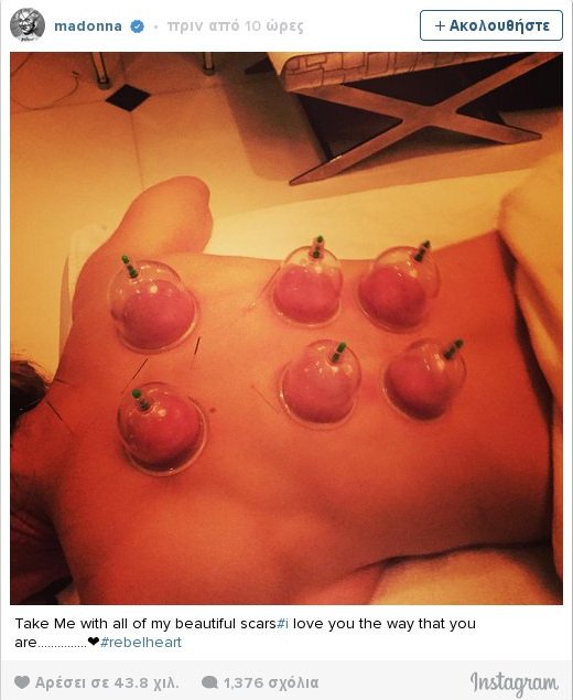 Μαντόνα: Γυμνή με βεντούζες στην πλάτη [εικόνα]  | iefimerida.gr 0