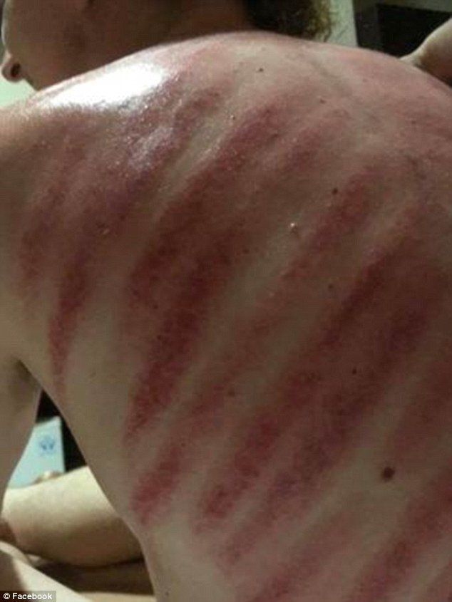 Σοκ έπαθε ένας Αυστραλιανός τουρίστας στο Μπαλί μόλις έμαθε πως το χαλαρωτικό μασάζ που έκανε κατά την διάρκεια των διακοπών του στο Μπαλί, του προκάλεσε τεράστιες κοκκινίλες στην πλάτη.