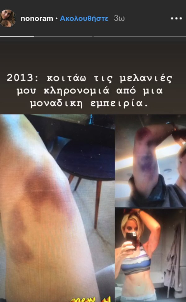 Η Ελεονώρα Μελέτη με μελανιές σε όλο της το σώμα -Τι συνέβη [εικόνα] | iefimerida.gr 0