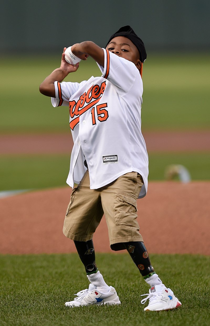 10χρονος έκανε μεταμόσχευση και στα δύο χέρια -Πώς τα χρησιμοποιεί σήμερα, 18 μήνες μετά [εικόνες & βίντεο] | iefimerida.gr 3