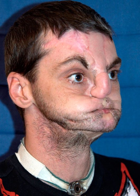  Η τελειότερη, ολική, μεταμόσχευση προσώπου έγινε στις ΗΠΑ [εικόνες] | iefimerida.gr 0