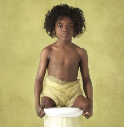 Η εκστρατεία ενημέρωσης για τη μηνιγγίτιδα, που προκαλεί δέος -Μικρές ακρωτηριασμένες ηρωίδες που νίκησαν το θάνατο [εικόνες] | iefimerida.gr 2