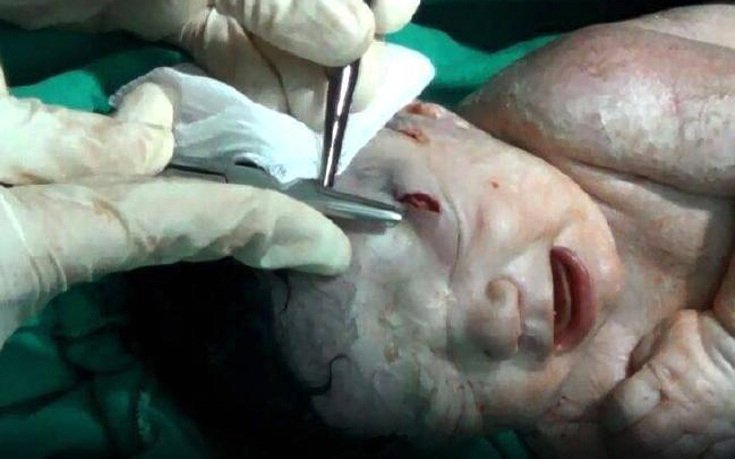 Συρία: Κοριτσάκι γεννήθηκε με θραύσμα οβίδας στο κεφάλι και έζησε [σκληρές εικόνες&βίντεο] | iefimerida.gr 0