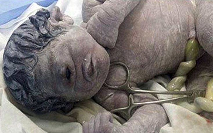 Μωρό-κύκλωπας: Σοκαριστική φωτογραφία που έδωσε στη δημοσιότητα η οικογένειά του [εικόνα] | iefimerida.gr 0