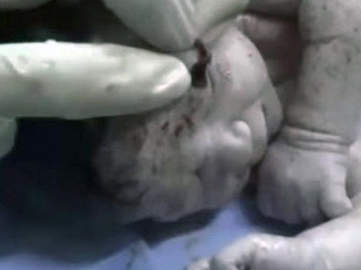 Συρία: Κοριτσάκι γεννήθηκε με θραύσμα οβίδας στο κεφάλι και έζησε [σκληρές εικόνες&βίντεο] | iefimerida.gr 1