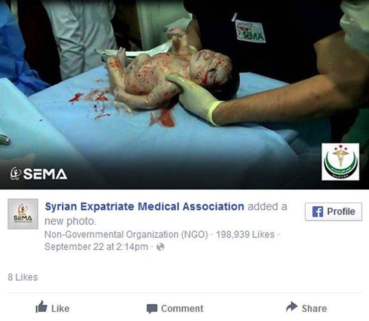 Συρία: Κοριτσάκι γεννήθηκε με θραύσμα οβίδας στο κεφάλι και έζησε [σκληρές εικόνες&βίντεο] | iefimerida.gr 2