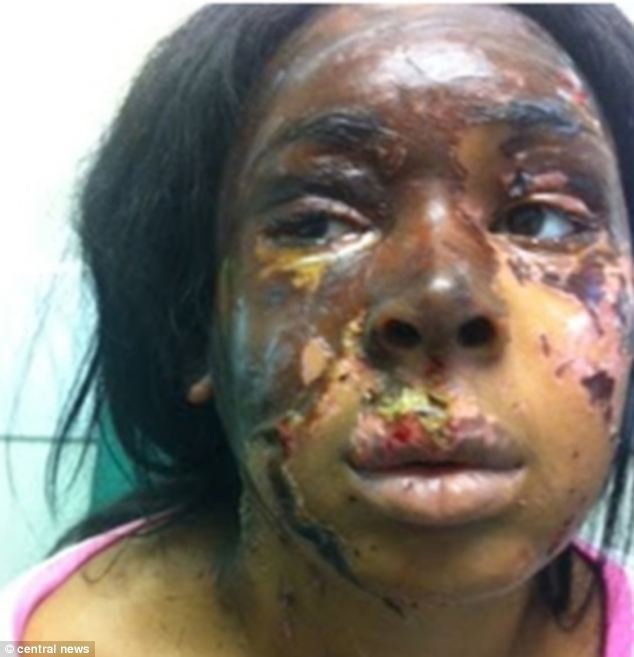 Μύριζε το δέρμα της που καιγόταν -Μοντέλο σοκάρει με τις αφηγήσεις για την επίθεση με οξύ που δέχτηκε [εικόνες]  | iefimerida.gr 0