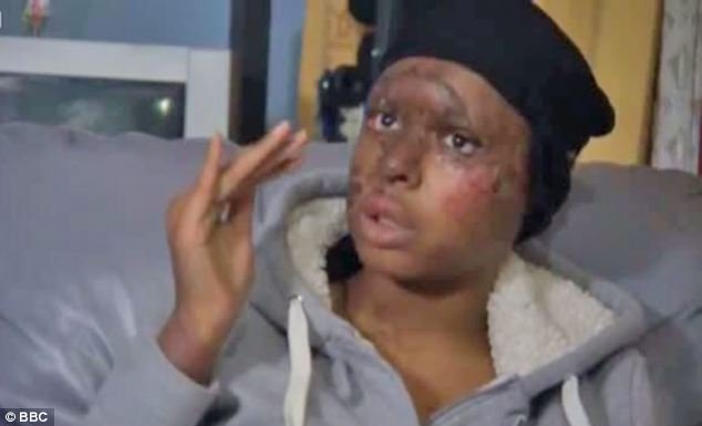 Μύριζε το δέρμα της που καιγόταν -Μοντέλο σοκάρει με τις αφηγήσεις για την επίθεση με οξύ που δέχτηκε [εικόνες]  | iefimerida.gr 2