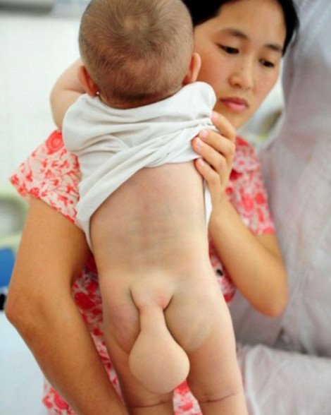 Η τραγική ιστορία του επτά μηνών αγοριού που ανέπτυξε μετά τη γέννησή του ουρά 10 εκατοστών [εικόνες] | iefimerida.gr 0