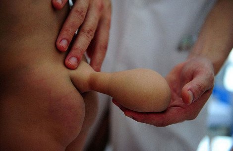 Η τραγική ιστορία του επτά μηνών αγοριού που ανέπτυξε μετά τη γέννησή του ουρά 10 εκατοστών [εικόνες] | iefimerida.gr 2