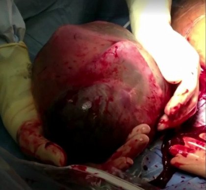 Σπάνιο, εκπληκτικό φαινόμενο: Μωρό στον αμνιακό σάκο, έξω από την κοιλιά της μητέρας του [εικόνες] | iefimerida.gr 2