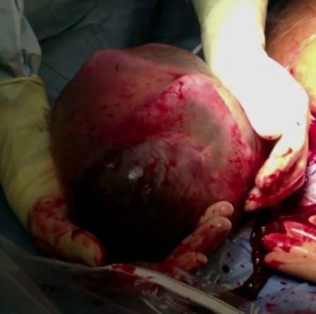 Σπάνιο, εκπληκτικό φαινόμενο: Μωρό στον αμνιακό σάκο, έξω από την κοιλιά της μητέρας του [εικόνες] | iefimerida.gr 3