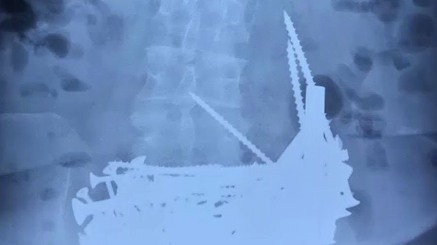 Χειρουργοί αφαίρεσαν 152 καρφιά, βίδες κι άλλα μεταλλικά αντικείμενα από το στομάχι Ρωσίδας [εικόνα]  | iefimerida.gr 0