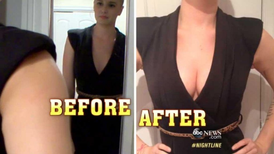 Τεράστιο στήθος για μια βραδιά -Η νέα τρέλα της Αμερικής [εικόνες] | iefimerida.gr 1