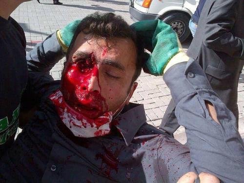 Σοκάρει η φωτογραφία του διαδηλωτή που δέχτηκε χτύπημα στο μάτι [εικόνα] | iefimerida.gr 0