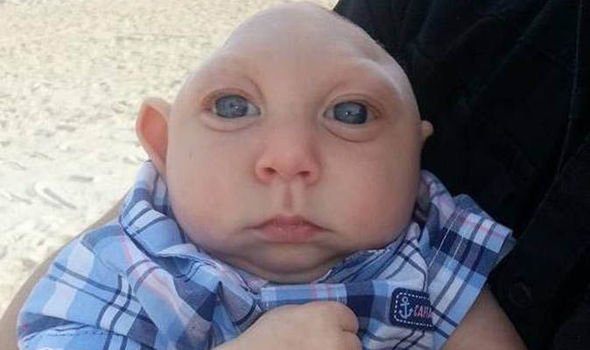 Γεννήθηκε με μισό κρανίο και εγκέφαλο και συγκινεί τον πλανήτη [εικόνες] | iefimerida.gr 1