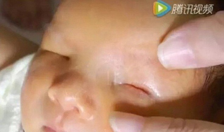 Συγκλονιστικό: Βρέφος στην Κίνα γεννήθηκε χωρίς μάτια [εικόνες & βίντεο] | iefimerida.gr 2