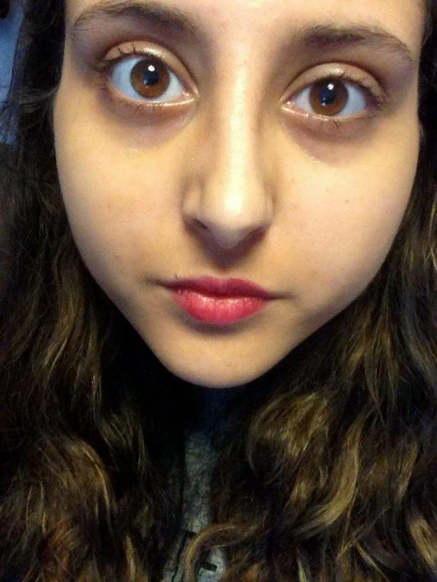 Εμεινε ξύπνια μια εβδομάδα για να εξοντώσει ένα παράσιτο που της έτρωγε το μάτι [εικόνες] | iefimerida.gr 2