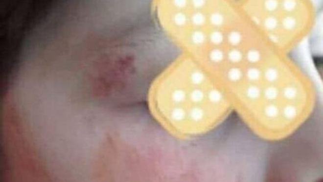 Σάλος στην Πάτρα: Μητέρα πήρε χτυπημένο το παιδί της από το σχολείο -Χρειάστηκε και ράμματα [εικόνα] | iefimerida.gr 0