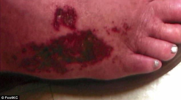 Πήγε σε σαλόνι ομορφιάς για πεντικιούρ και έφυγε με εγκαύματα γ' βαθμού [εικόνες & βίντεο] | iefimerida.gr 2